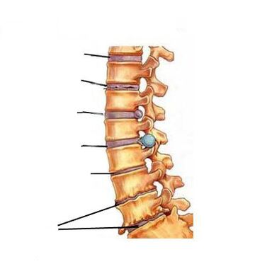 Cómo se desarrolla la osteocondrosis